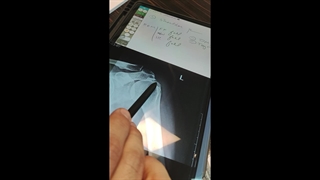 رسوب کلسیم در مفصل شانه