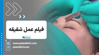 عمل جراحی لیفت شقیقه - پزشک 24