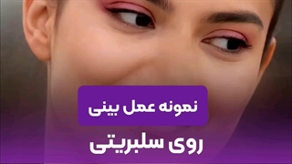 قبل و بعد از عمل بینی سلبریتی ها