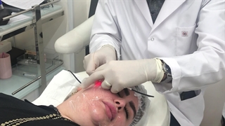لیزر اندولیفت صورت | دکتر علی اکبر داورپناه
