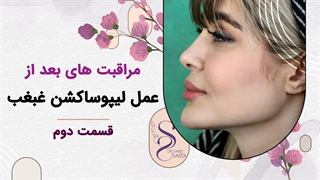 مراقبت بعد از لیپوساکشن غبغب2