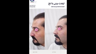 لیفت بینی با نخ