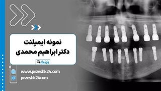 نمونه ایمپلنت دندان دکتر ابراهیم محمدی در تهران - پزشک 24