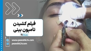 فیلم کشیدن تامپون بینی بعد عمل - پزشک 24