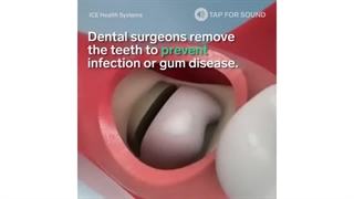 چه زمانی کشیدن دندان عقل ضروری است؟