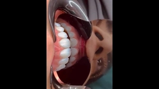 نمونه کارهای دکتر دندانپزشک قاسمیان - با بیمه ملت در ملارد