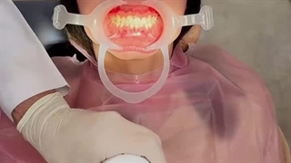 صفر تا صد باندینگ ارتودنسی