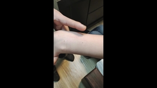 تشخیص کیست گانگلیون