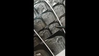 زمان تعویض مفصل شانه