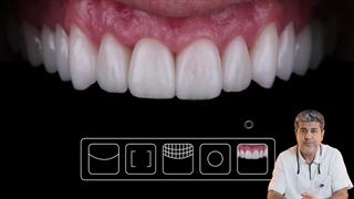 لمینت دندان برای چه نوع دندان‌هایی مناسب است؟ | توضیحات دکتر افشین میرزایی