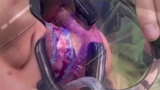 بلیچینگ دندان بصورت تخصصی در مطب