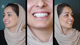 نتیجه ایمپلنت دندان خانم برومند در کلینیک بارانا مشهد