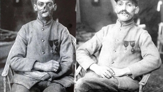 لِ گُل کَسِی؛ درباره افرادی که جانشان را نجات دادند اما صورت هایشان را در سنگرها جا گذاشتند