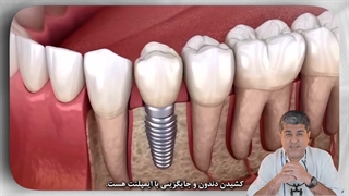 چرا بعضی دندونا بعد از عصب‌کشی آبسه می‌کنن؟ علت و درمان علمی با توضیح دکتر افشین میرزایی