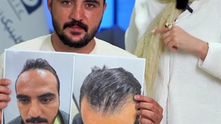 «نتیجه کاشت مو بعد از یک سال | تراکم طبیعی و رشد کامل موها»