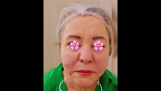 جوانسازی صورت با نخ