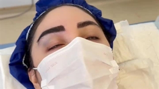 کاشت ابرو به روش میکرو sut بدون جراحی
