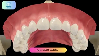 خوردگی کامل دو دندان شماره ۲ از دست رفته با ایمپلنت | سلامت کاشت درین
