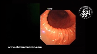 آندوسکوپی در فق دیافراگم وسیع با معده داخل قفسه سینه