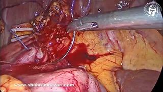 بررسی مجرای صفراوی مشترک به روش لاپاراسکوپی برای سنگ صفراوی در شکست‌ ERCP