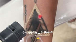✨ ریموو تتو با جدیدترین تکنولوژی لیزر