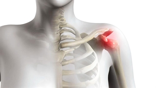سندرم گیر کردن شانه Impingement چیست؟