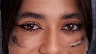 جراحی لبخند لثه ای