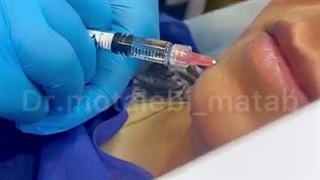 تزریق فیلر پروفایلو | جوانسازی طبیعی و آبرسانی عمیق پوست
