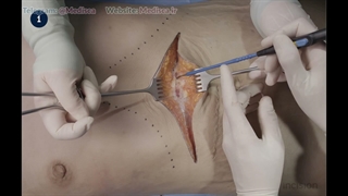 3 Abdominal Wall Incision - Chevron