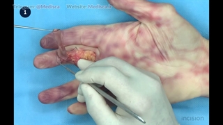 15 Skin Graft - Full Thickness