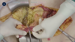 10 Bowel Anastomosis - End-to-End Handsewn