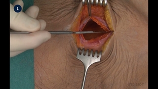 13 GI Catheters - Feeding Gastrostomy (Janeway)