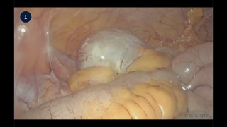 19 Laparoscopic Ileocecal Resection