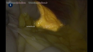 21 Laparoscopic Mobilization Splenic Flexure