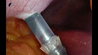 24 Laparoscopic Roux-en-Y Gastric Bypass