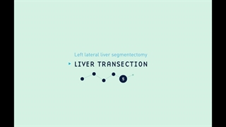 27 Left Lateral Liver Segmentectomy