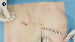 38 Open Feeding Jejunostomy