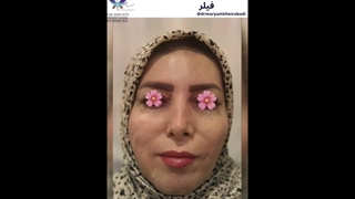 فیلر خط لبخند و خط اخم