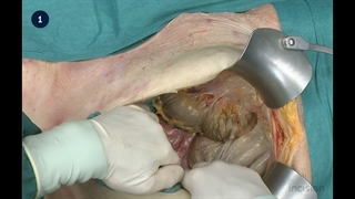 52 Open Sigmoidectomy - Neoplastic