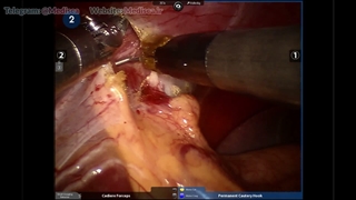 60 Robot Assisted Heller Myotomy