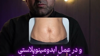 آیا جراحی ابدومینوپلاستی ترک‌های پوستی شکم رو از بین میبره؟