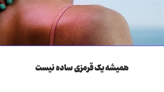 بهترین محصول برای آفتاب سوختگی