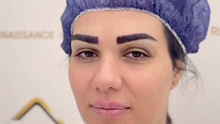 طراحی ابروها به وسیله لیزر در کلینیک سینا همان رنسانس معروف