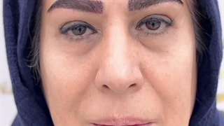 کاشت ابرو بدون جراحی به روش میکرو sut