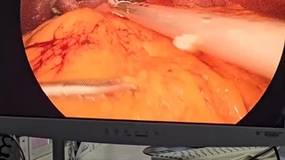 جراحی لاپاراسکوپی سرطان انتهای معده