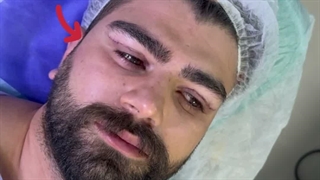 بلفاروپلاستی پلک بالا در کلینیک آرتین