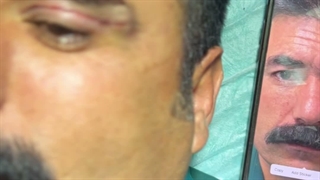 رفع افتادگی پلک در کلینیک آرتین