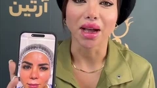 لیفت سانترال لب در کلینیک آرتین